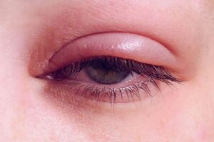 nguyen nhan gay viem mi mat