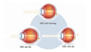 vừa cận thị vừa loạn thị