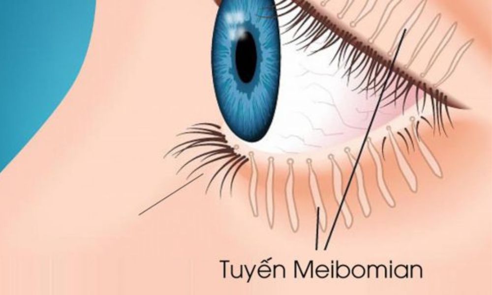 Vi&ecirc;m bờ mi sau