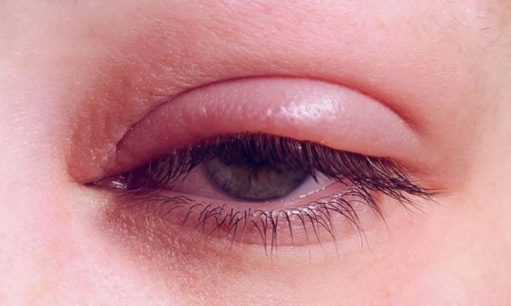 vi&ecirc;m m&iacute; mắt l&agrave; g&igrave;