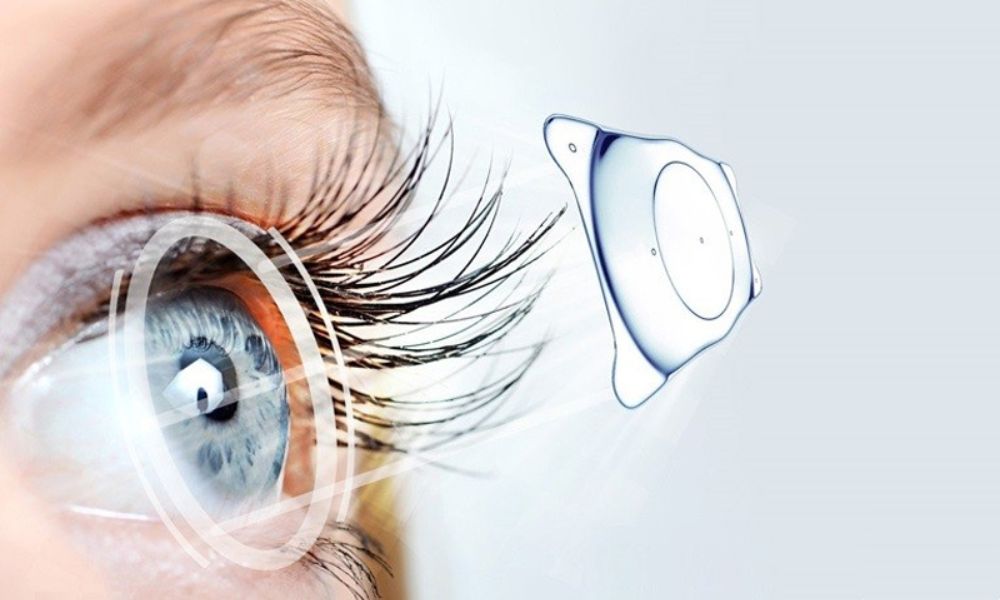 Phương ph&aacute;p Phakic IOL