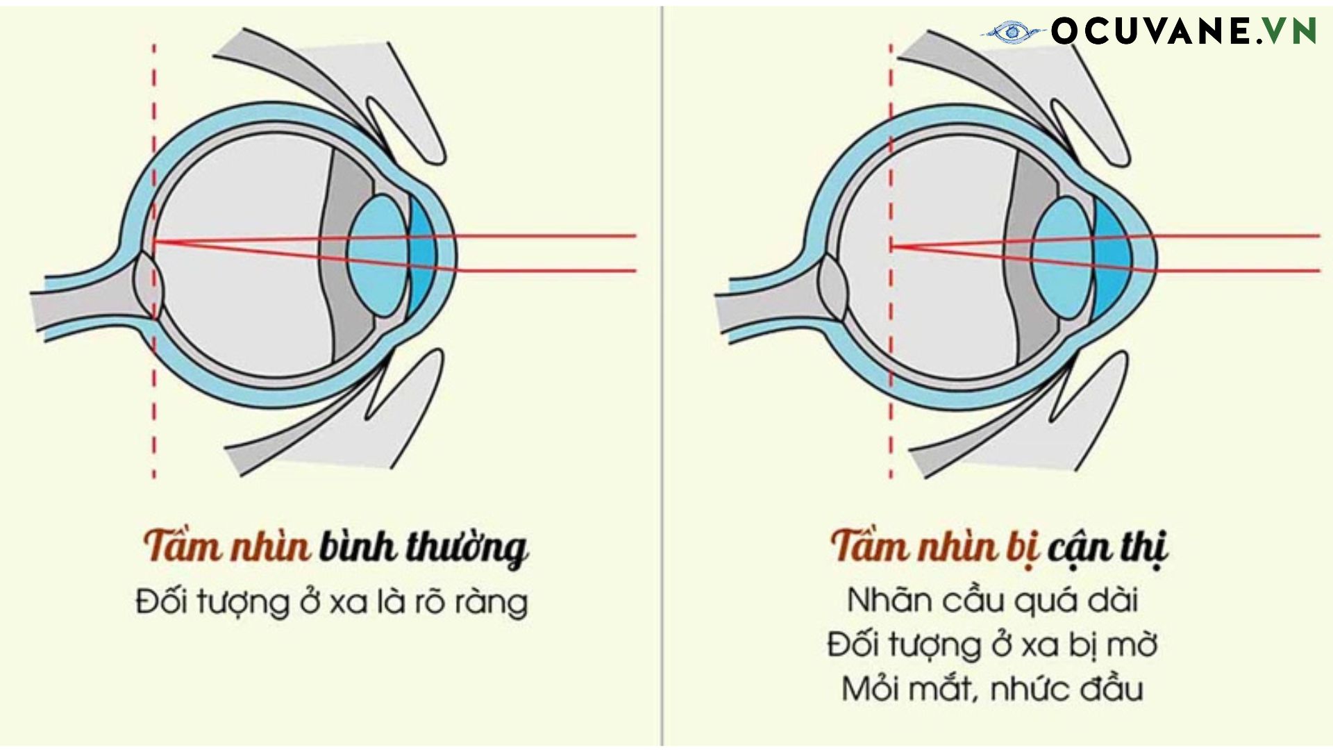 Bài Tập Cho Mắt Cận: Top 11 Bài Tập Hiệu Quả 2 Luyện mắt có chữa được cận thị không?