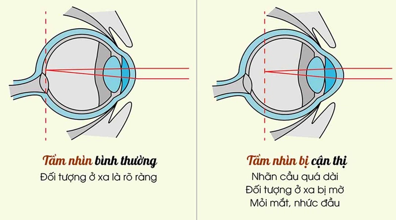 Bài Tập Cho Mắt Cận: Top 7 Bài Tập Hiệu Quả 2 Luyện Mắt Có Chữa Được Cận Thị Không?
