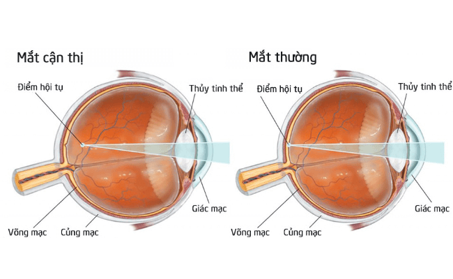 Cách Khắc Phục Mắt Cận: Hiệu Quả Tự Nhiên, Không Xâm Lấn 2 Cách khắc phục mắt cận -Cận Thị Là Gì? Phân Loại Cận Thị Để Khắc Phục Đúng Cách