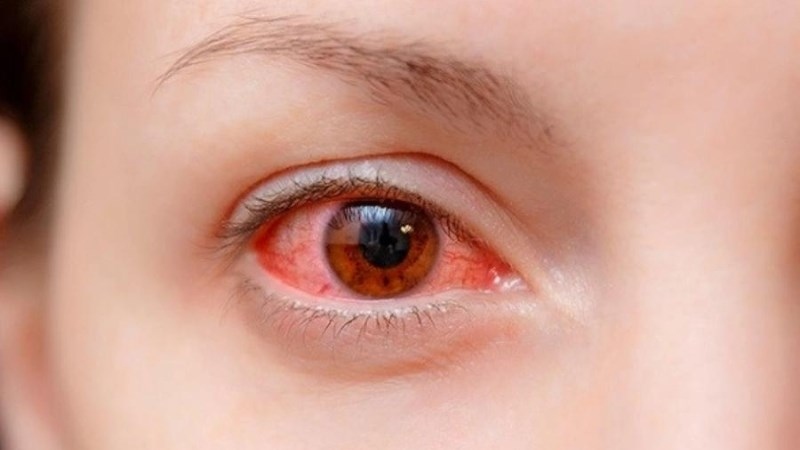 Có nên đeo kính áp tròng khi ngủ trưa? 4 Có nên đeo kính áp tròng khi ngủ trưa- Lỡ đeo kính áp tròng khi ngủ trưa thì có sao không?