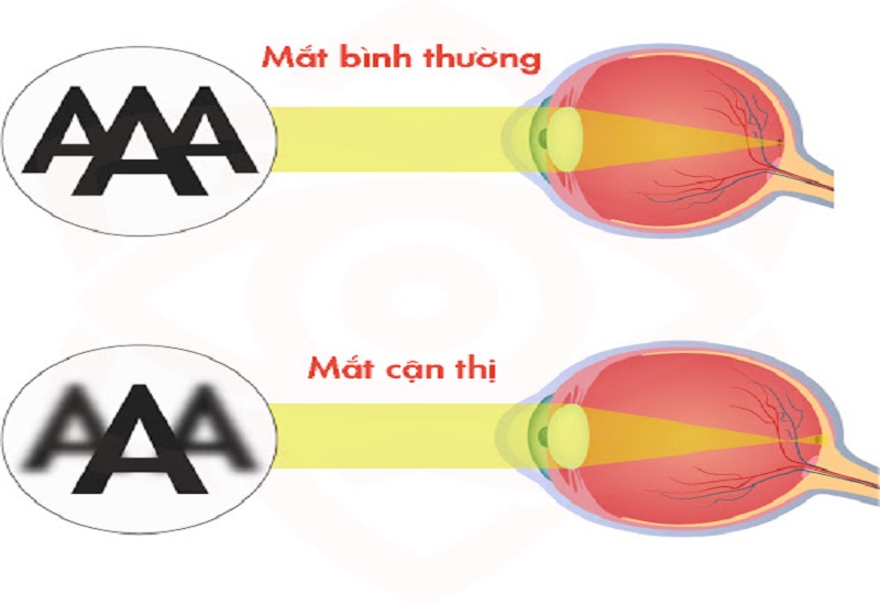 Mắt 8/10 Là Cận Bao Nhiêu Độ? Hiểu Rõ Và Xử Lý Đúng Cách 1 Mắt 8/10 là cận bao nhiêu độ