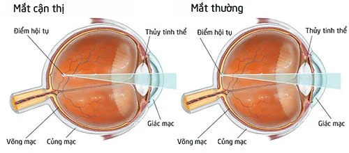 Mổ mắt cận có đau không? Giải đáp chi tiết từ A đến Z 2 Mổ mắt cận là gì-Mổ mắt cận là gì? Các phương pháp phổ biến hiện nay