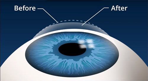 Mổ Mắt Chữa Cận Thị – Những Điều Cần Biết Trước Khi Quyết Định 2 Mổ mắt chữa cận thị -Mổ mắt chữa cận thị là gì