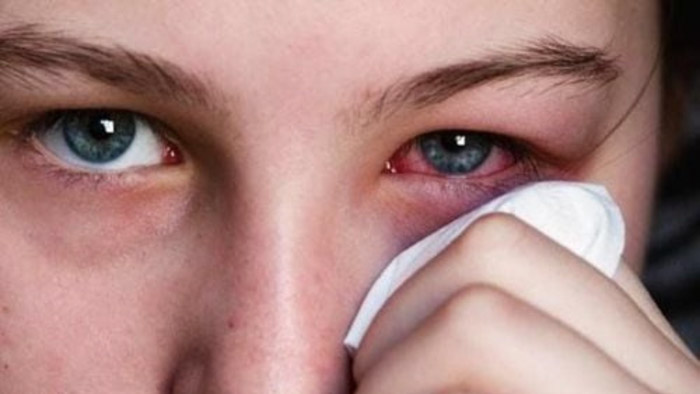 Kính áp tròng cận thị – Giải pháp thay thế kính gọng 5 Tác hại khi đeo kính áp tròng cận